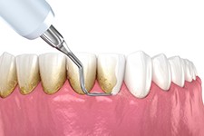 Illustration of scaler removing plaque from teeth