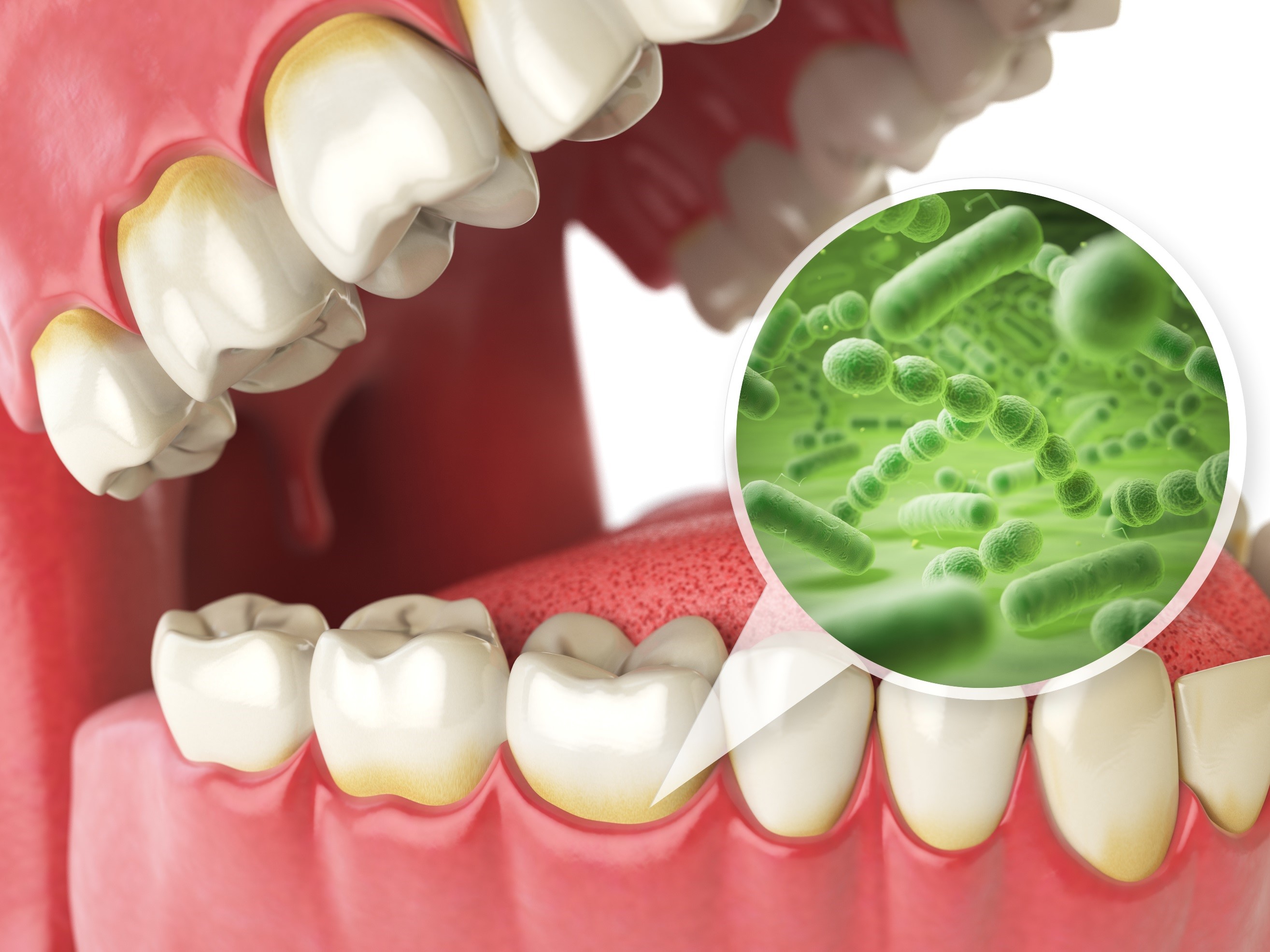 Causes Of Red Sore On Gums